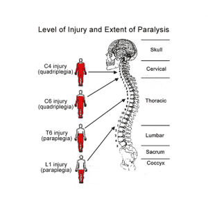 Paraplegia-Spinal-Cord-Injury